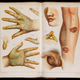 Skin lesions caused by exposure to arsenic, as conveyed in this 1859 medical book.